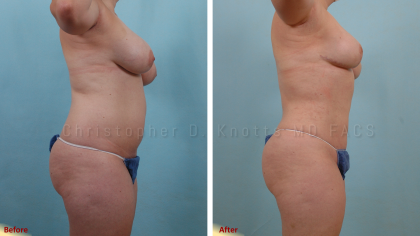 Liposuction Photos - Dr. Chen Plastic Surgery New Mexico